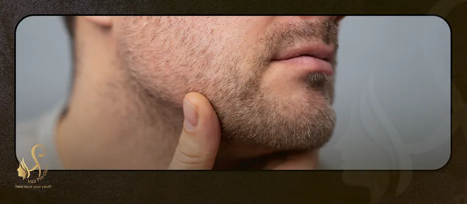 Chin Hair Transplant Cost in Egypt