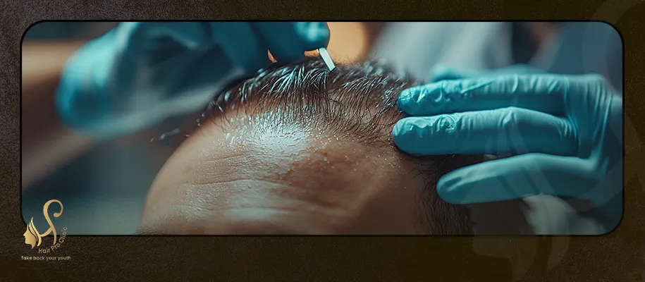 Best Hair Transplant Clinics in Cairo