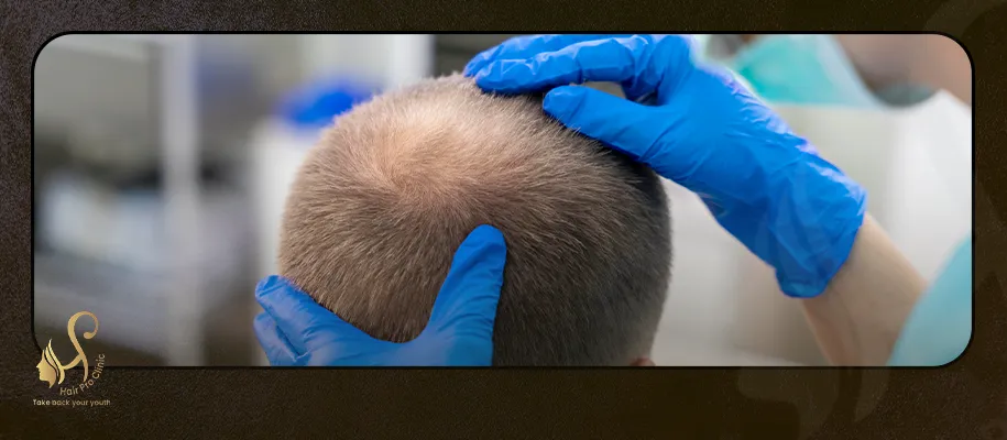 The use of stem cells in the treatment of hair loss
