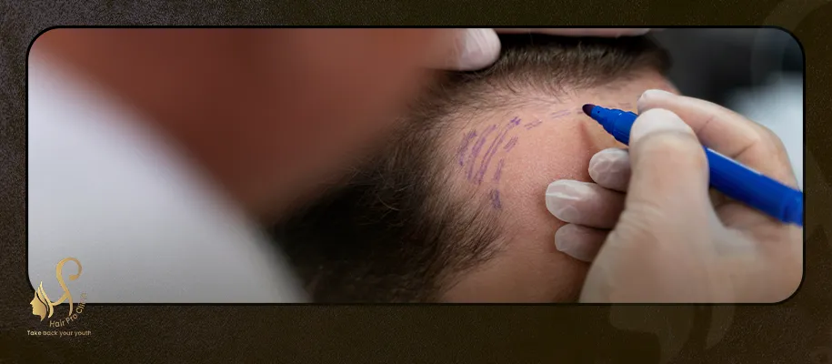 Best Treatment for Hereditary Baldness for Men