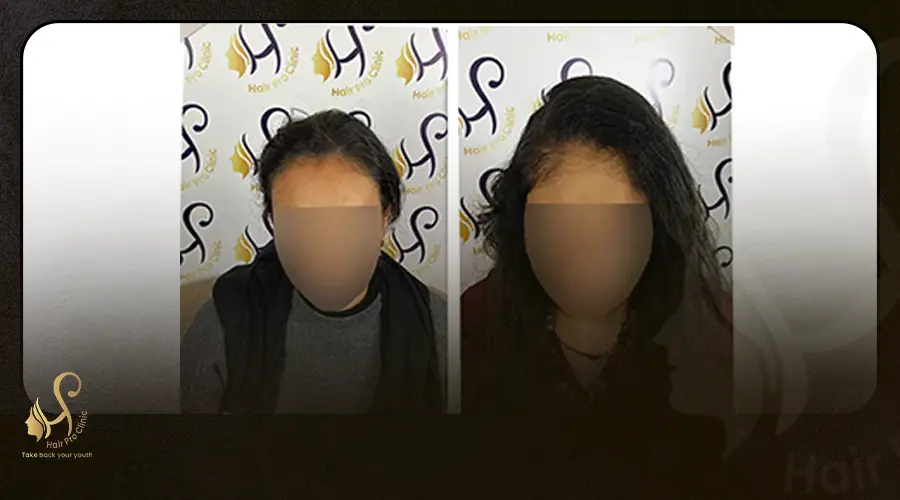 زراعة الشعر للنساء