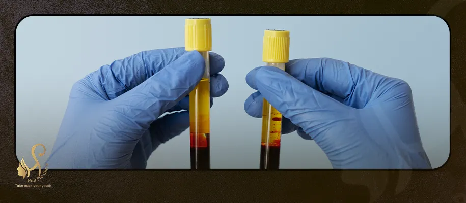 PRP (Platelet-Rich Plasma)