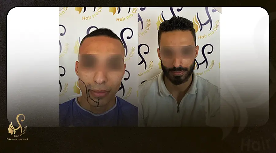زراعة اللحية
